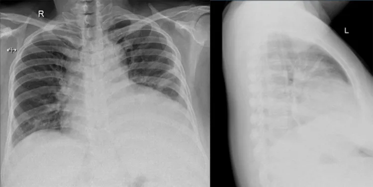 A patient, who was diagnosed with Ovarian Cancer