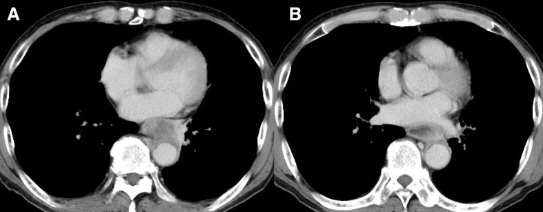 A patient, who was diagnosed with Gastric Adenocarcinoma