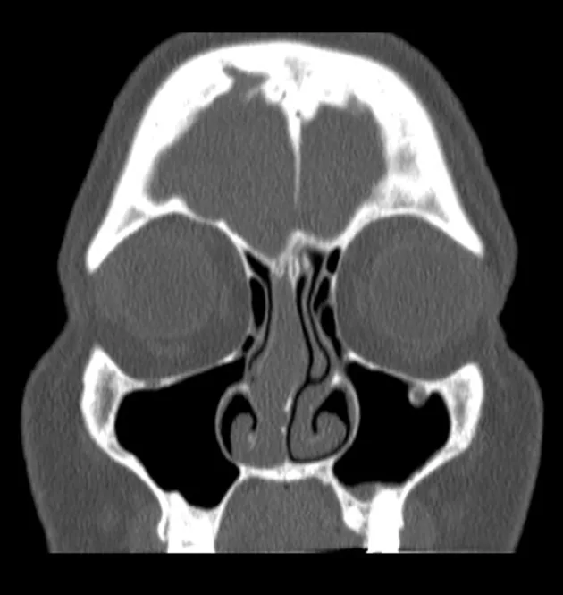 A patient, who was diagnosed with Stage IV Invasive Lobular Carcinoma
