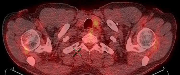 A patient, who was diagnosed with Colorectal Adenocarcinoma