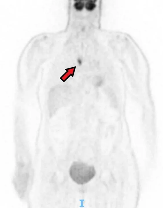 A patient, who was diagnosed with Small Cell Lung Cancer