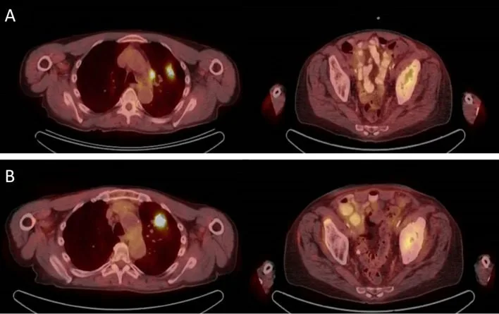 A patient, who was diagnosed with Stage IV Non-Small Cell Lung Cancer