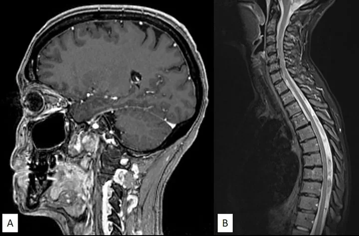 A patient, who was diagnosed with Invasive Ductal Carcinoma