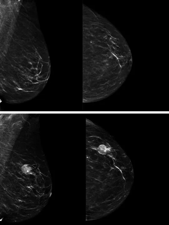 A patient, who was diagnosed with Breast Cancer