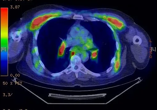 A patient, who was diagnosed with Stage IV Colorectal Adenocarcinoma