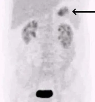 A patient, who was diagnosed with Gastric Cancer