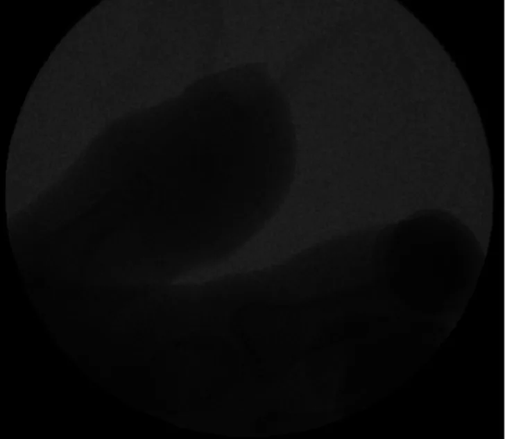 A patient, who was diagnosed with Gastric Adenocarcinoma