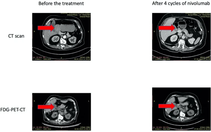 A patient, who was diagnosed with Gastric Adenocarcinoma