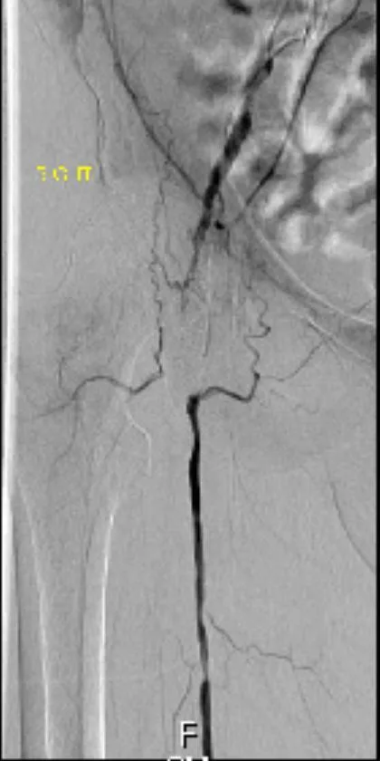 A patient, who was diagnosed with Stage IV Non-Small Cell Lung Cancer