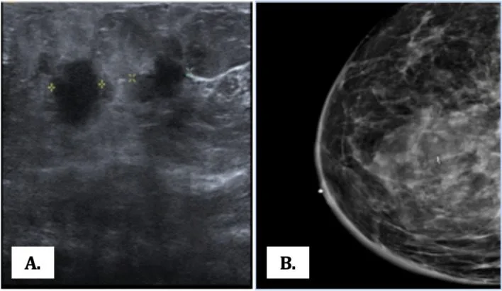 A patient, who was diagnosed with Stage IV Invasive Ductal Carcinoma