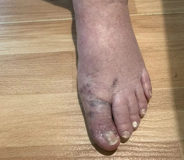 A patient, who was diagnosed with Stage III Non-Small Cell Lung Cancer