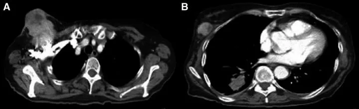 A patient, who was diagnosed with Stage IV Lung Adenocarcinoma