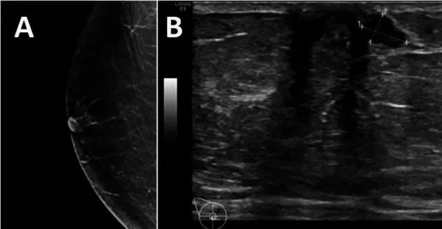 A patient, who was diagnosed with Stage 0 Invasive Ductal Carcinoma