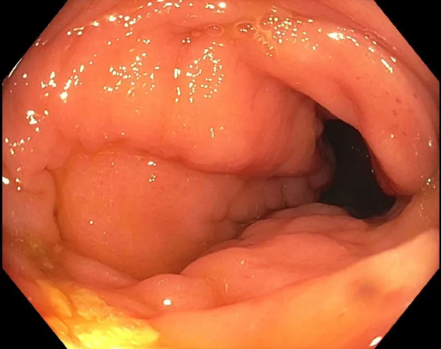 A patient, who was diagnosed with Stage IV Invasive Lobular Carcinoma