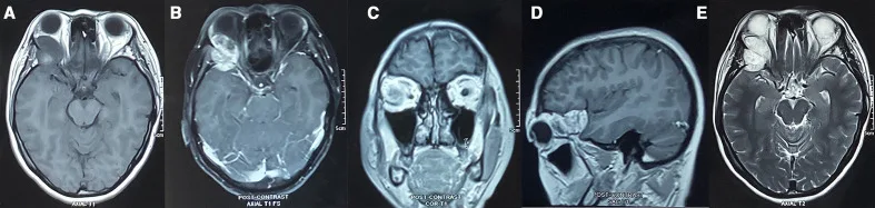 A patient, who was diagnosed with Stage IV Breast Cancer