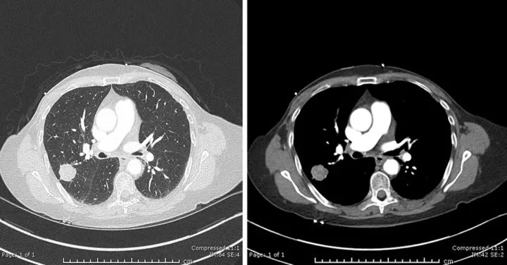 A patient, who was diagnosed with Lung Squamous Cell Carcinoma