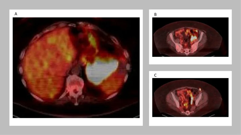 A patient, who was diagnosed with Ovarian Cancer