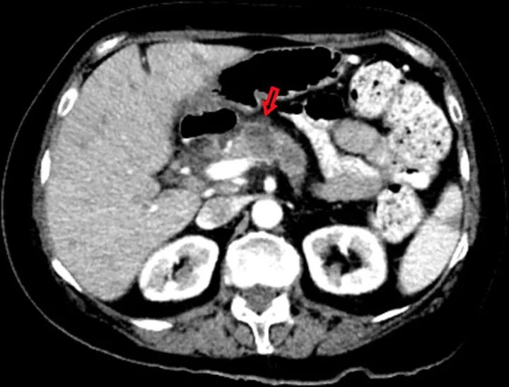 A patient, who was diagnosed with Breast Cancer