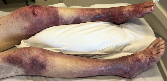 A patient, who was diagnosed with Stage IV Colorectal Cancer