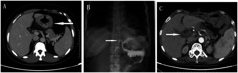 A patient, who was diagnosed with Stage III Gastric Adenocarcinoma
