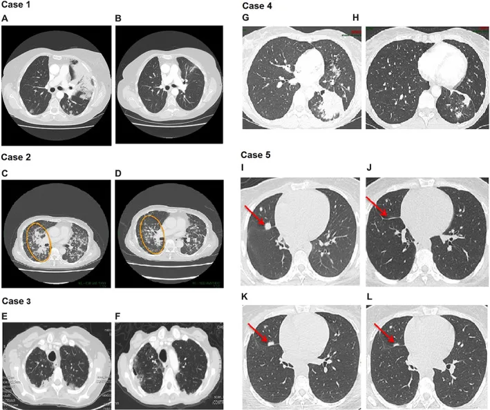 A patient, who was diagnosed with Stage IV Colorectal Adenocarcinoma