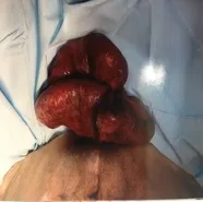A patient, who was diagnosed with Stage IV Colorectal Adenocarcinoma