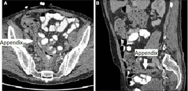 A patient, who was diagnosed with Stage I Colorectal Adenocarcinoma