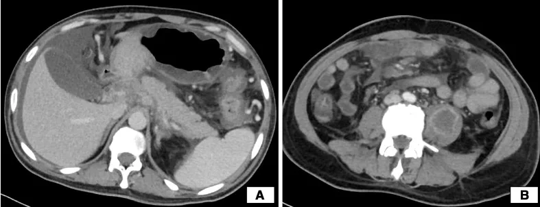 A patient, who was diagnosed with Gastric Adenocarcinoma