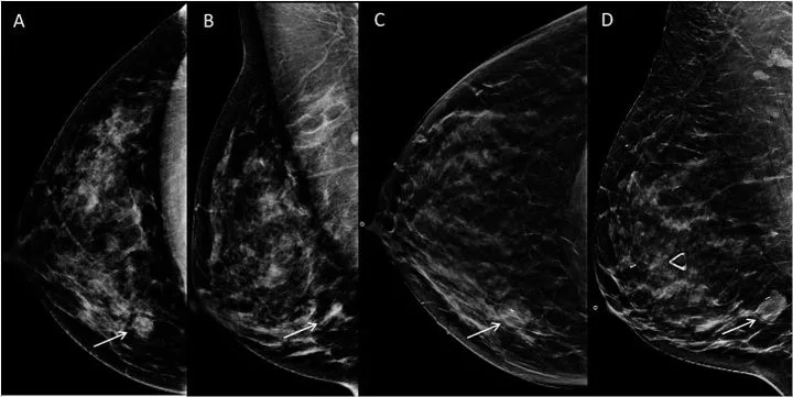 A patient, who was diagnosed with Invasive Lobular Carcinoma