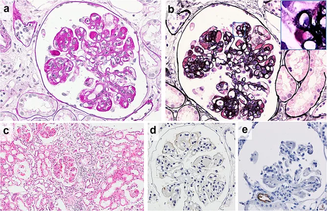 A patient, who was diagnosed with Stage IV Ovarian Adenocarcinoma