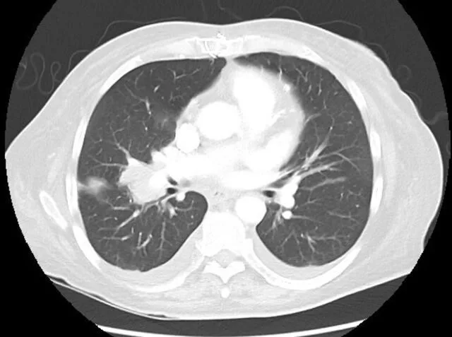A patient, who was diagnosed with Small Cell Lung Cancer