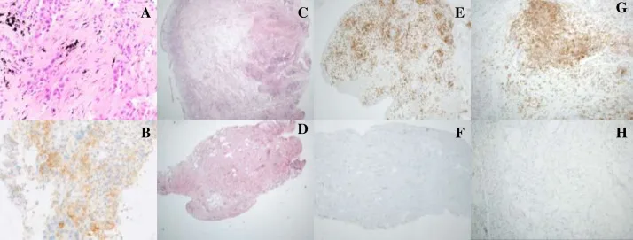 A patient, who was diagnosed with Non-Small Cell Lung Cancer