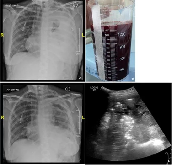 A patient, who was diagnosed with Lung Adenocarcinoma
