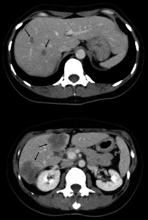 A patient, who was diagnosed with Stage IV Colorectal Adenocarcinoma