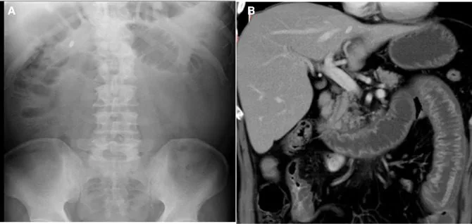 A patient, who was diagnosed with Stage III Lung Adenocarcinoma
