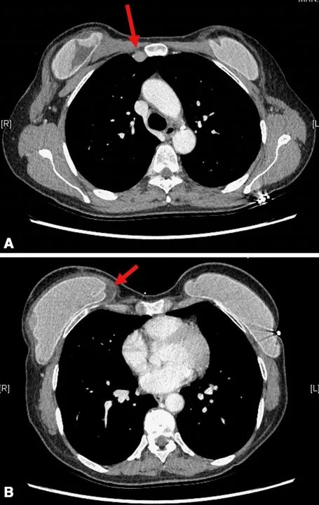 A patient, who was diagnosed with Breast Cancer