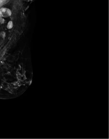 A patient, who was diagnosed with Stage IV Invasive Ductal Carcinoma