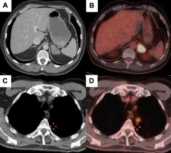 A patient, who was diagnosed with Stage IV Lung Cancer
