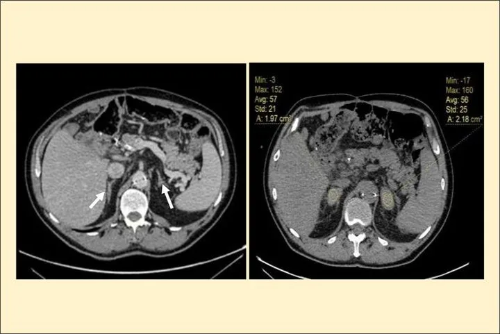 A patient, who was diagnosed with Stage IV Colorectal Adenocarcinoma