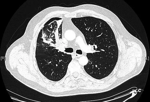 A patient, who was diagnosed with Lung Cancer