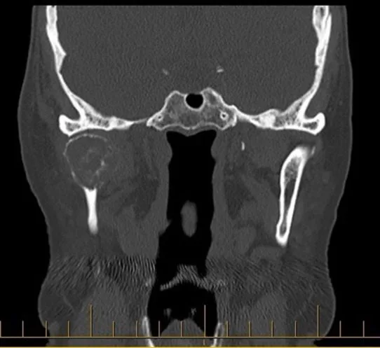 A patient, who was diagnosed with Stage IV Invasive Ductal Carcinoma
