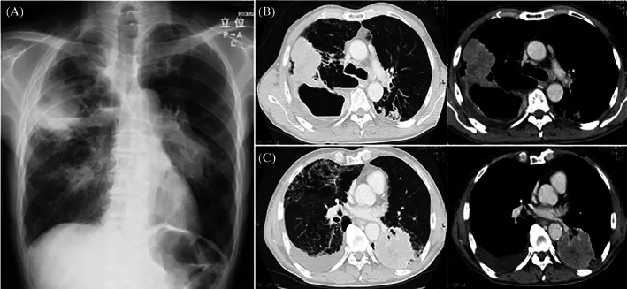 A patient, who was diagnosed with Small Cell Lung Cancer