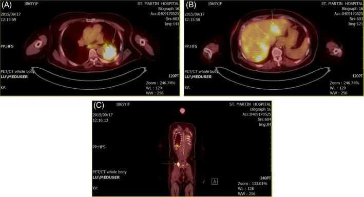 A patient, who was diagnosed with Small Cell Lung Cancer