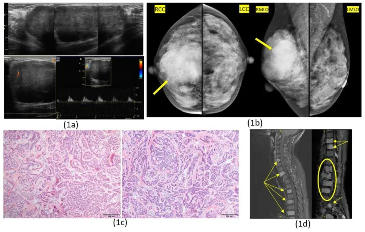 A patient, who was diagnosed with Breast Cancer