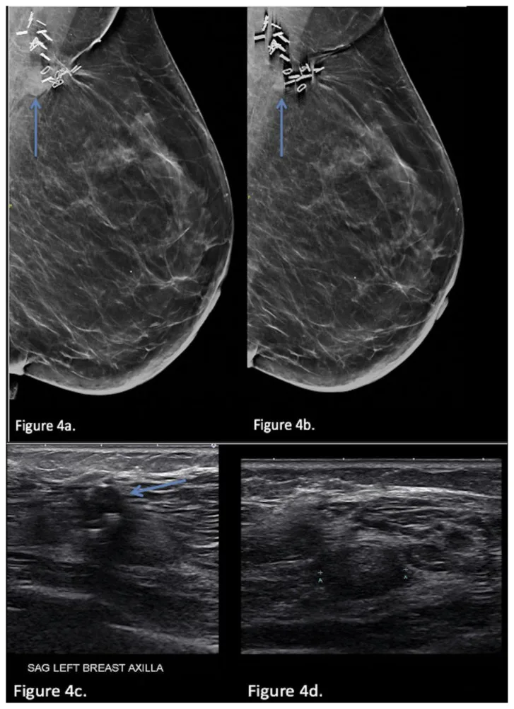 A patient, who was diagnosed with Invasive Ductal Carcinoma