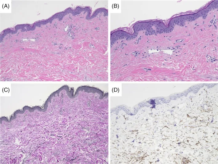A patient, who was diagnosed with Stage IV Invasive Ductal Carcinoma