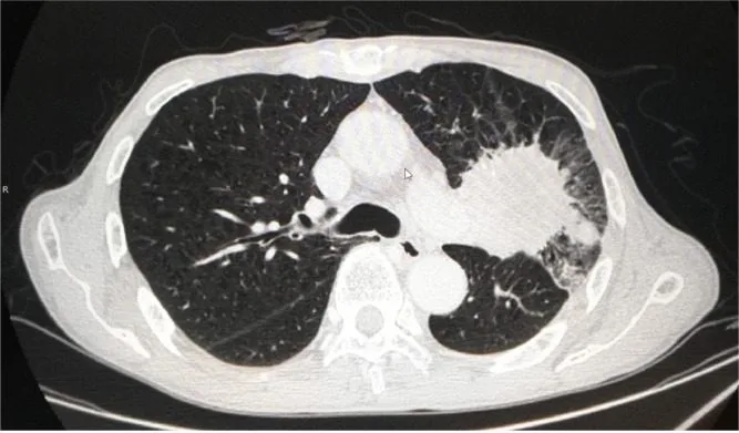 A patient, who was diagnosed with Stage III Lung Adenocarcinoma