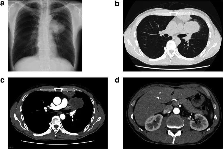 A patient, who was diagnosed with Lung Squamous Cell Carcinoma