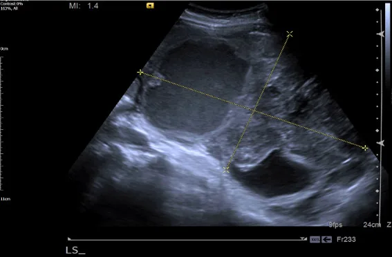 A patient, who was diagnosed with Ovarian Adenocarcinoma