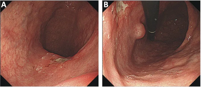 A patient, who was diagnosed with Gastric Adenocarcinoma